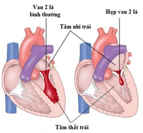 Bệnh Hở Van Tim